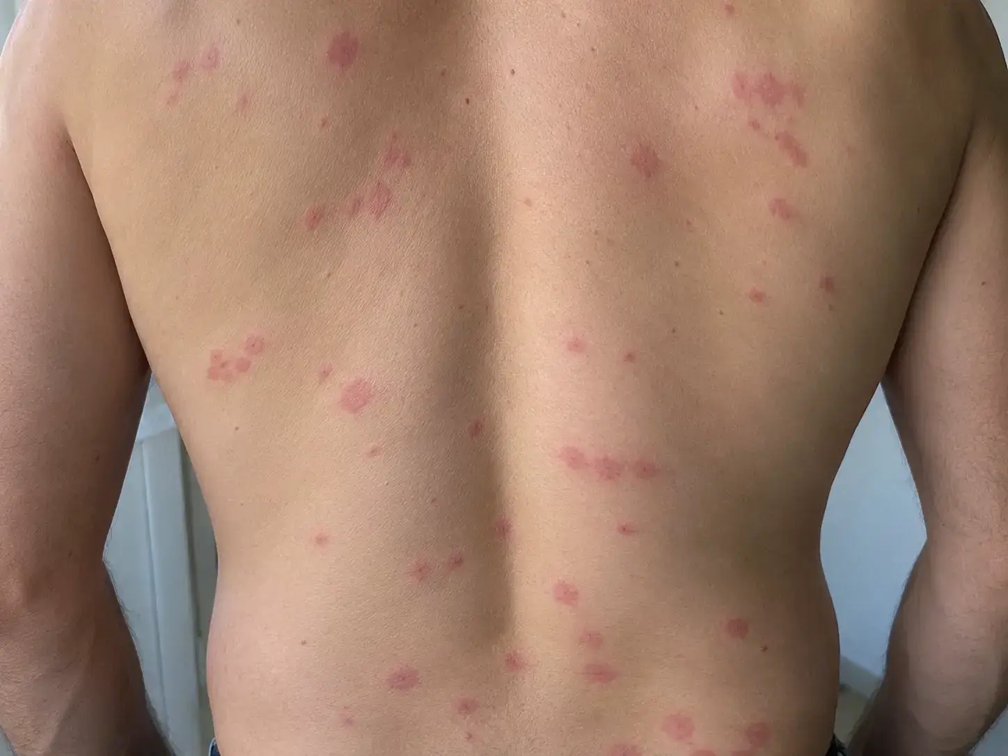 Photo de piqûres de punaises de lit sur le dos