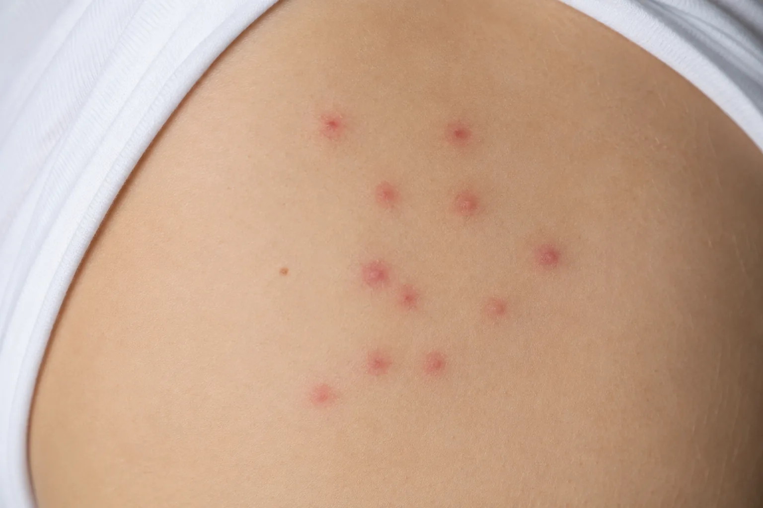 Piqûres de punaises de lit sur la peau : boutons rouges alignés sur l'épaule
